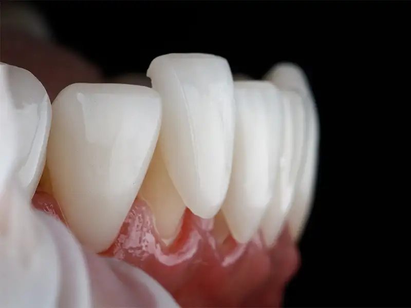 Gualini - faccette dentali Gualini - faccette dentali