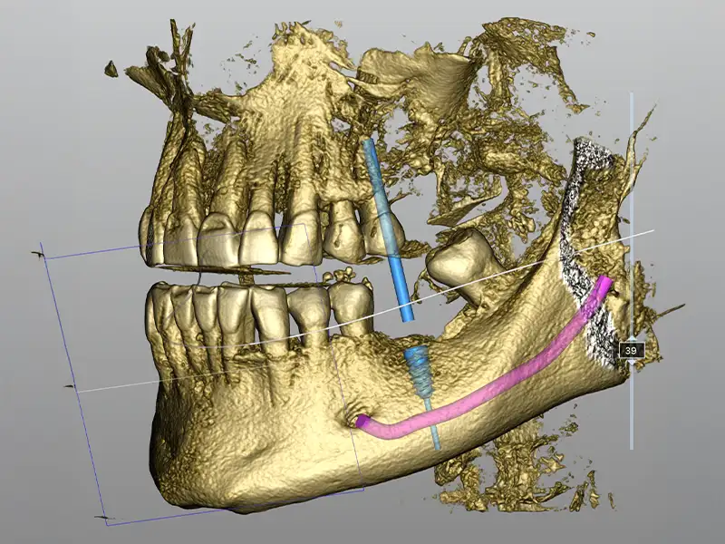 Implantologia guidata Implantologia guidata