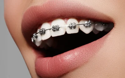 Cos’è l’ortodonzia e a cosa serve?